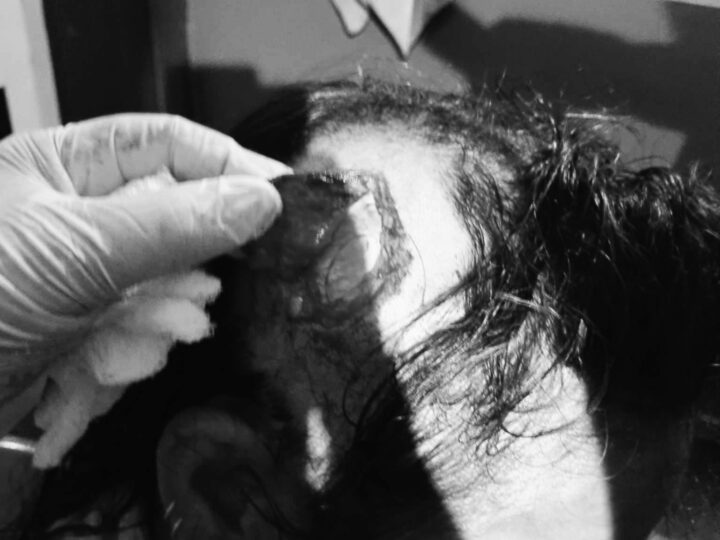 भालुले आक्रमण गर्दा तनहुँमा कल्पना घाइते