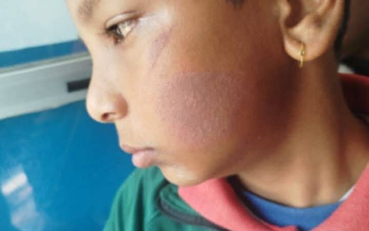 स्कुलमा हल्ला गरेको भन्दै भिमादमा मिसले बालकलाई तातो पनियाेले डामिन् !