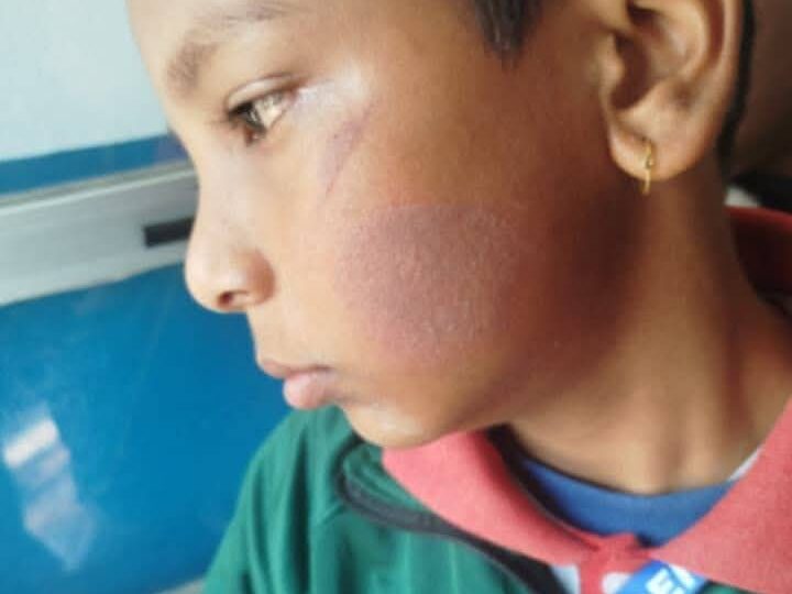स्कुलमा हल्ला गरेको भन्दै भिमादमा मिसले बालकलाई तातो पनियाेले डामिन् !