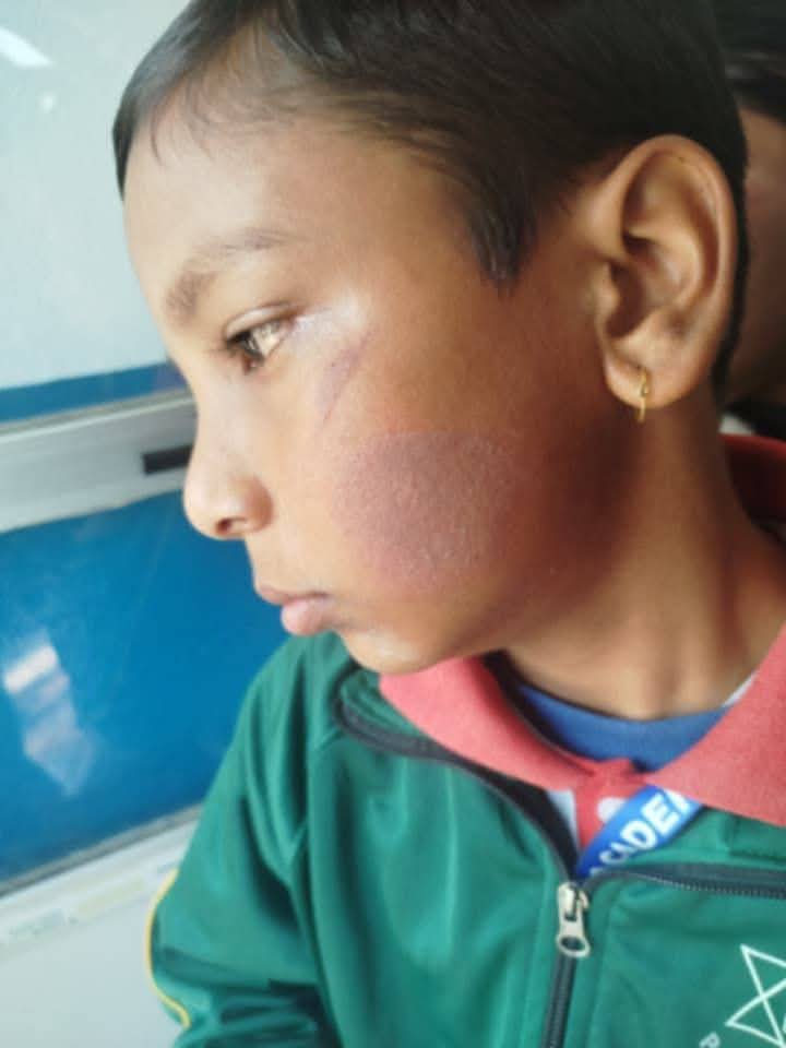 स्कुलमा हल्ला गरेको भन्दै भिमादमा मिसले बालकलाई तातो पनियाेले डामिन् !