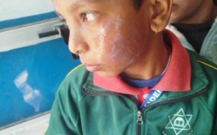 बच्चालाई पनियाेले डाम्ने भिमादकी मिसलाइ १७ दिन थुन्न आदेश , पनियाे तताउने राना समेत पक्राउ !