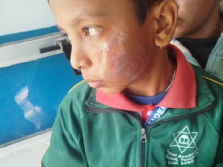 बच्चालाई पनियाेले डाम्ने भिमादकी मिसलाइ १७ दिन थुन्न आदेश , पनियाे तताउने राना समेत पक्राउ !